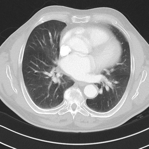 File:Brain metastasis (large cystic mass) (Radiopaedia 47497-52104 Axial lung window 26).png