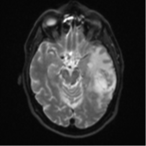 Brain metastasis (large cystic mass) (Radiopaedia 47497-52107 Axial DWI 10).png