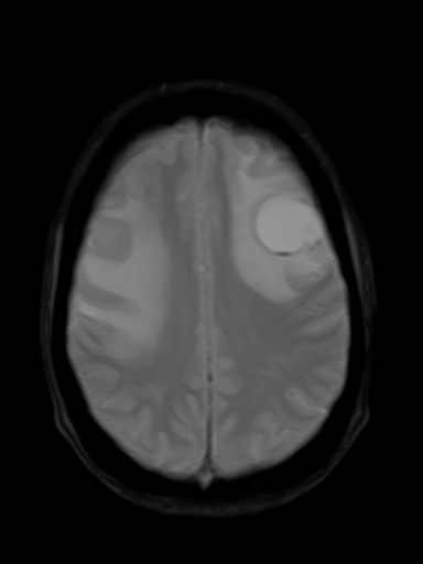 File:Brain metastasis as initial presentation of non-small cell lung cancer (Radiopaedia 65122-74126 Axial T2* 14).jpg