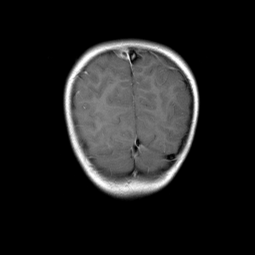 File:Brainstem ganglioglioma (Radiopaedia 10763-11224 Coronal T1 C+ 3).jpg
