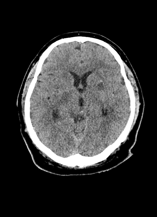 Brainstem hemorrhage (Radiopaedia 81294-94976 Axial non-contrast 34).jpg