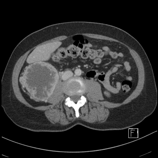 File:Breast metastases from renal cell cancer (Radiopaedia 79220-92225 C 55).jpg