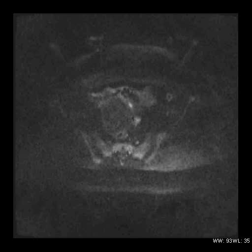 File:Broad ligament fibroid (Radiopaedia 49135-54241 Axial DWI 15).jpg