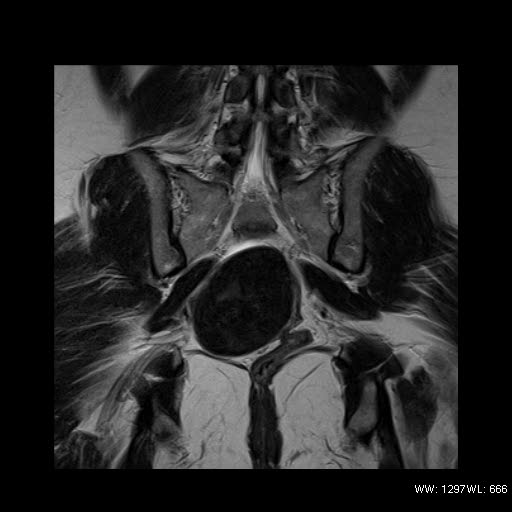 File:Broad ligament fibroid (Radiopaedia 49135-54241 Coronal T2 20).jpg