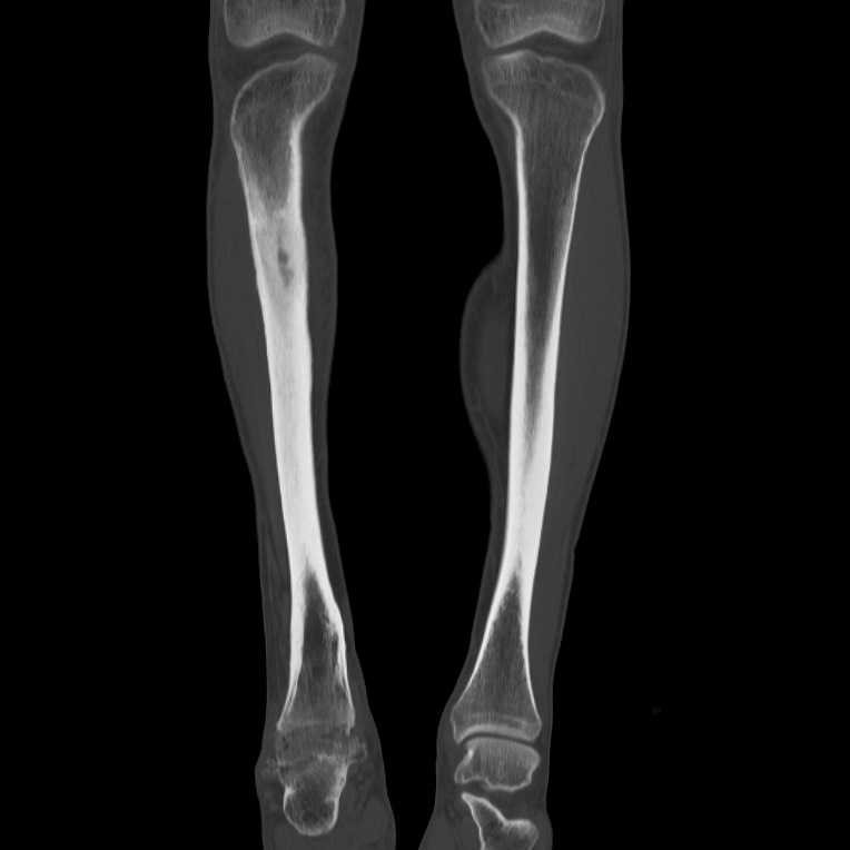 Brodie abscess - tibia (Radiopaedia 66028-75204 Coronal bone window 13).jpg