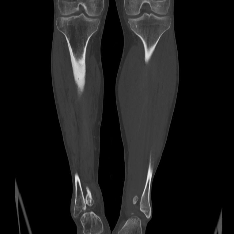 Brodie abscess - tibia (Radiopaedia 66028-75204 Coronal bone window 43).jpg