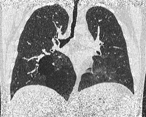 Bronchial atresia (Radiopaedia 58271-65417 Coronal lung window 30).jpg
