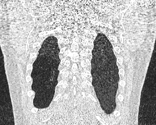File:Bronchial atresia (Radiopaedia 58271-65417 Coronal lung window 53).jpg