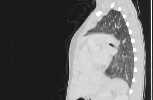 Bronchial mucoepidermoid carcinoma (Radiopaedia 57023-63895 Sagittal lung window 121).jpg