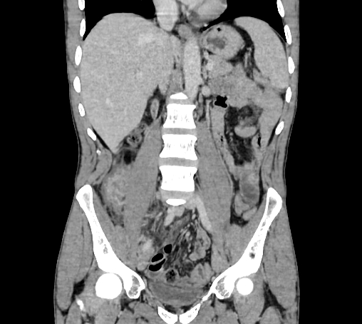Bronchiectasis in Crohn disease (Radiopaedia 60311-67977 C 41).jpg