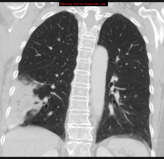 Bronchoalveolar carcinoma (BAC) (Radiopaedia 13436-13392 Coronal lung window 39).jpg