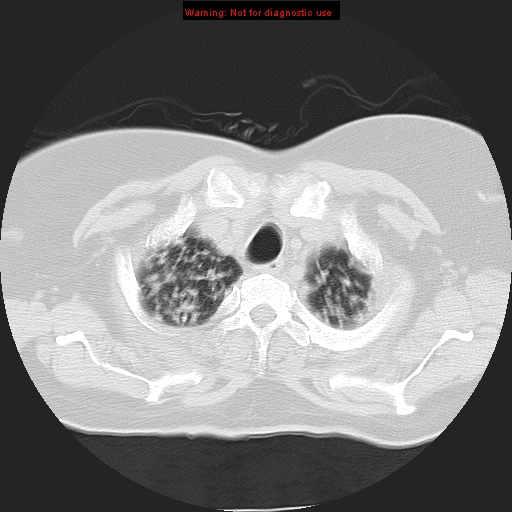 File:Bronchoalveolar carcinoma (Radiopaedia 13224-13233 Axial lung window 8).jpg