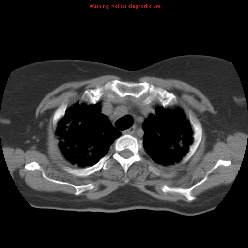 Bronchoalveolar carcinoma (Radiopaedia 13224-13233 Axial non-contrast 10).jpg