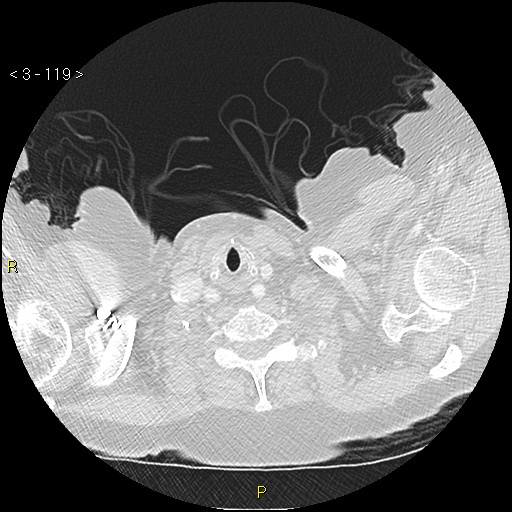 Bronchogenic carcinoma as an incidental finding (Radiopaedia 16453-16130 Axial lung window 119).jpg