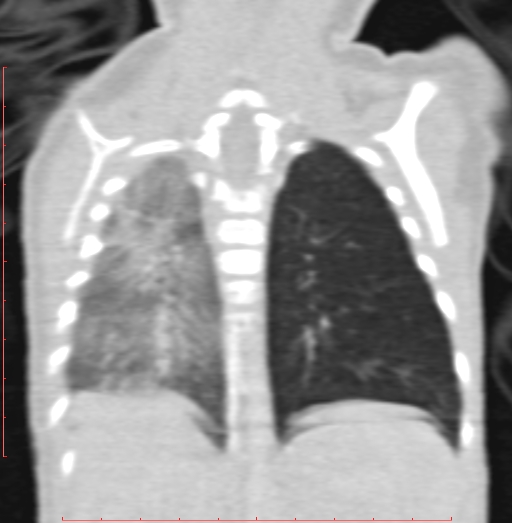Bronchogenic cyst (Radiopaedia 78599-91409 Coronal lung window 165).jpg