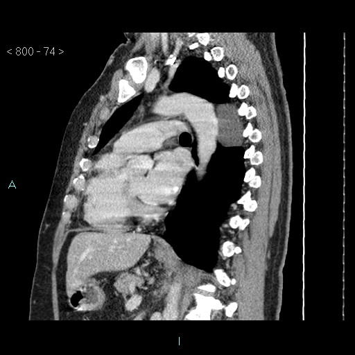 Bronchogenic cyst - posterior mediastinal (Radiopaedia 43885-47364 B 49).jpg