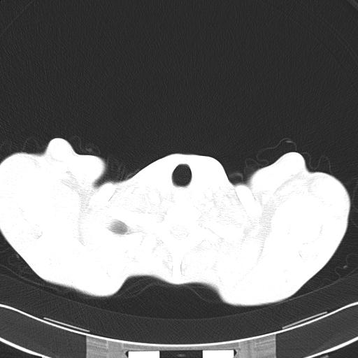 Bronchopleural fistula secondary to tuberculosis (Radiopaedia 20415-20322 Axial lung window 5).jpg
