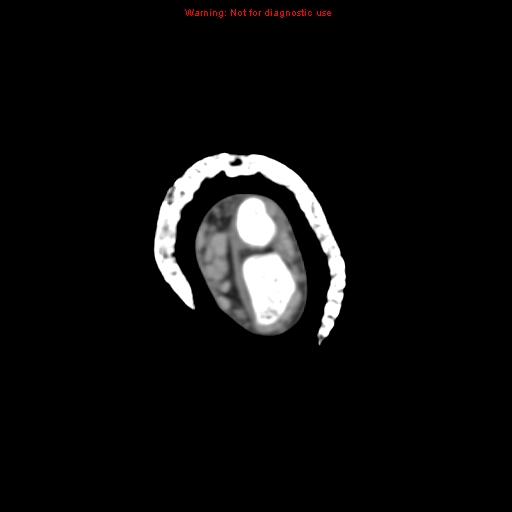 File:Brown tumor (Radiopaedia 12460-12694 Axial non-contrast 22).jpg