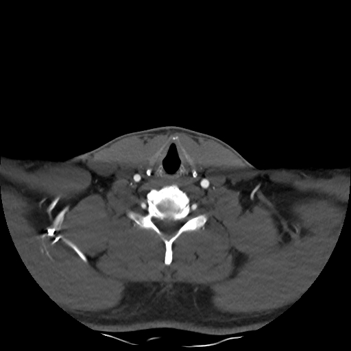 Buccal fat pad arteriovenous malformation (Radiopaedia 70936-81144 A 83).jpg