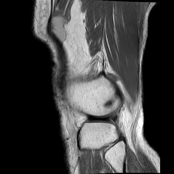 File:Bucket handle tear - medial meniscus (Radiopaedia 29250-29664 Sagittal PD 3).jpg