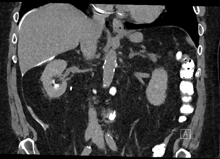 Buried bumper syndrome - gastrostomy tube (Radiopaedia 63843-72577 Coronal Inject 75).jpg