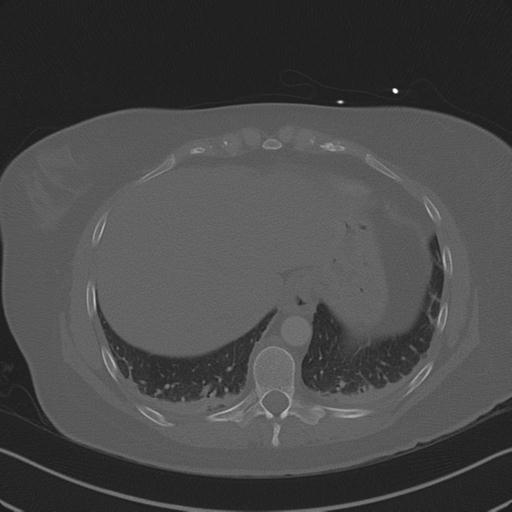 Burst fracture - thoracic spine (Radiopaedia 30238-30865 Axial bone window 72).jpg