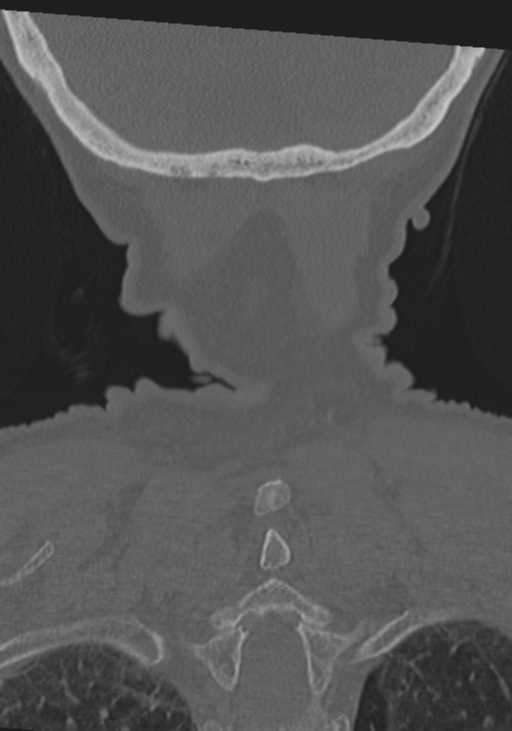 C2 fracture with vertebral artery dissection (Radiopaedia 37378-39199 Coronal bone window 54).png