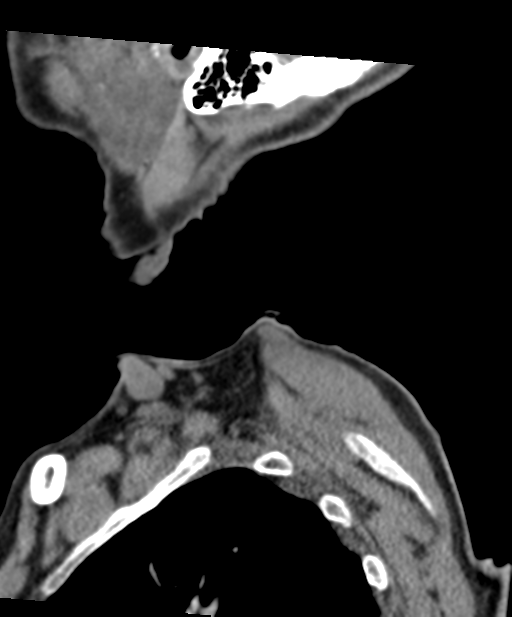 C2 fracture with vertebral artery dissection (Radiopaedia 37378-39199 D 5).png