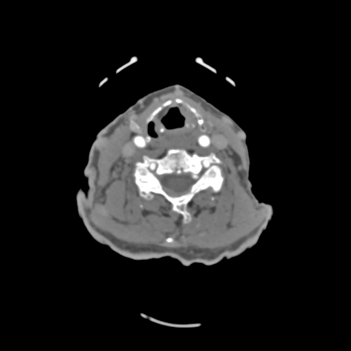C2 fracture with vertebral artery dissection (Radiopaedia 37378-39200 A 116).png