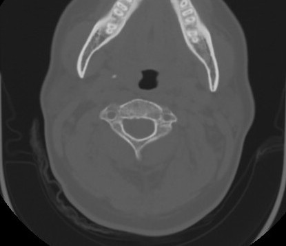 C7 laminar fracture and Klippel-Feil syndrome (Radiopaedia 86710-102850 Axial bone window 31).jpg
