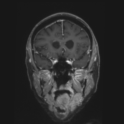File:CNS lymphoma with steroid response (Radiopaedia 37980-39921 Coronal T1 C+ 13).png
