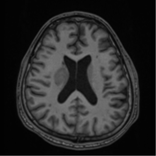 CNS vasculitis (Radiopaedia 55715-62263 Axial T1 48).png