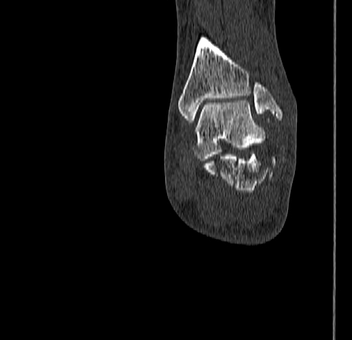 Calcaneal fracture - Sanders type 4 (Radiopaedia 90179-107370 Coronal bone window 67).jpg