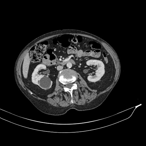 Calcified adrenal glands and Spigelian hernia (Radiopaedia 49741-54988 A 97).jpg