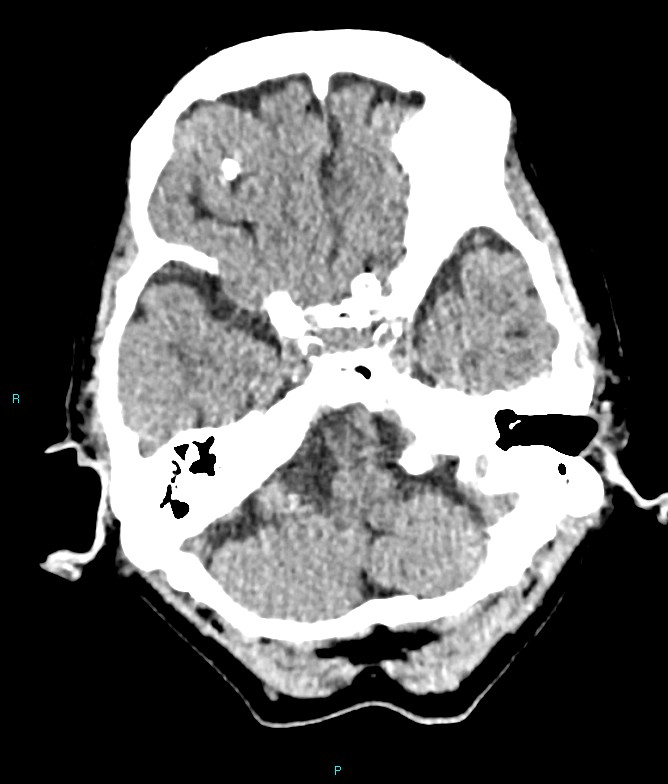 Calcified cerebral emboli from left ventricular thrombus (Radiopaedia 84420-99758 Axial non-contrast 73).jpg