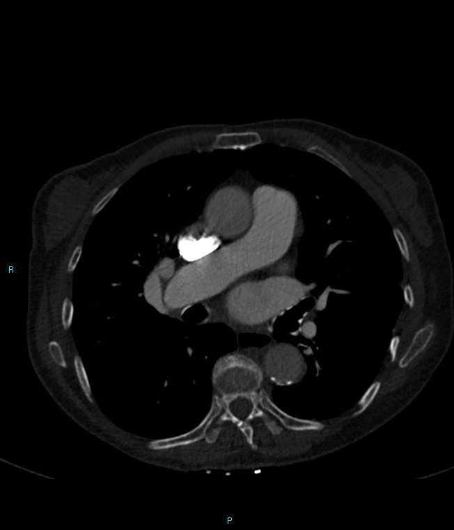 Calcified cerebral emboli from left ventricular thrombus (Radiopaedia 84420-99760 Axial bone window 39).jpg