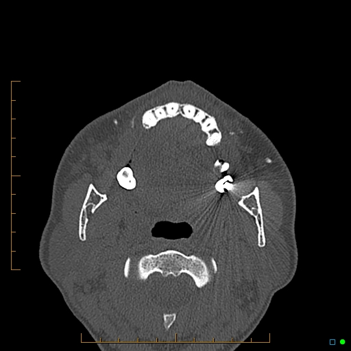 Calcified facial augmentation fillers (Radiopaedia 79514-92679 Axial bone window 92).jpg
