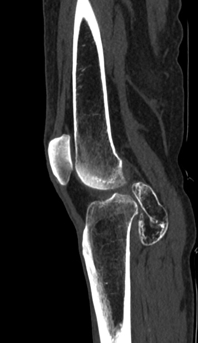 Calcified hematoma - popliteal fossa (Radiopaedia 63938-72763 Sagittal bone window 62).jpg