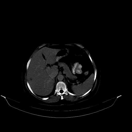 File:Calcified hydatid cyst of the liver (Radiopaedia 21212-21112 Axial bone window 15).jpg