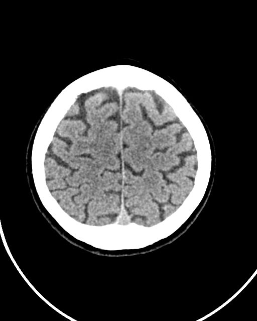 Calcified meningioma (Radiopaedia 74361-85243 Axial non-contrast 11).jpg