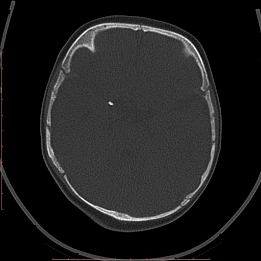 Calcified middle cerebral artery embolism (Radiopaedia 78949-91860 Axial bone window 18).jpg
