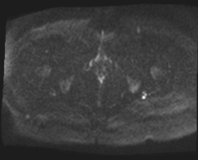 Cancer cervix - stage IIb (Radiopaedia 75411-86615 Axial DWI 59).jpg