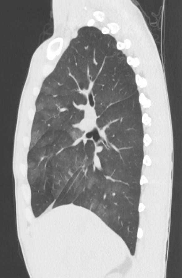 Cannabis-induced diffuse alveolar hemorrhage (Radiopaedia 89834-106946 Sagittal lung window 50).jpg