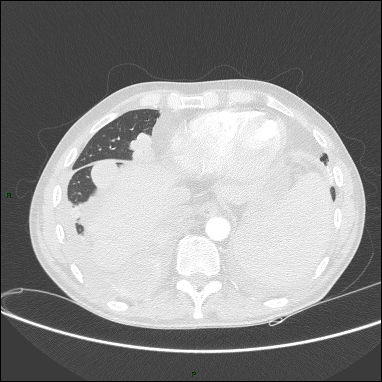 Cannonball metastases (Radiopaedia 82110-96150 Axial lung window 151).jpg