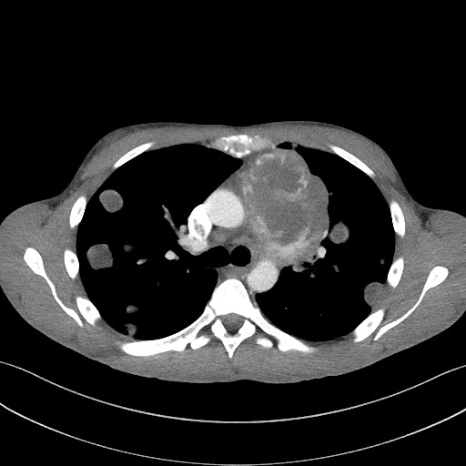 File:Cannonball metastases - testicular choriocarcinoma (Radiopaedia 84510-99891 B 49).jpg