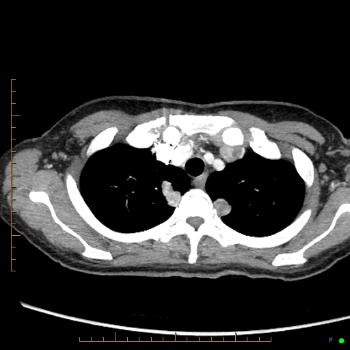 File:Canonball lung metastasis (Radiopaedia 77634-89837 B 14).jpg