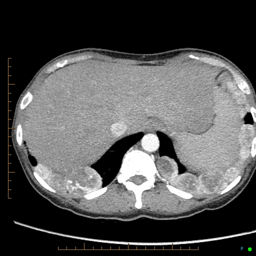 File:Canonball lung metastasis (Radiopaedia 77634-89837 B 90).jpg