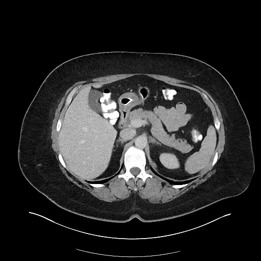 Carcinoid tumor - terminal ileum (Radiopaedia 60931-68739 A 40).jpg