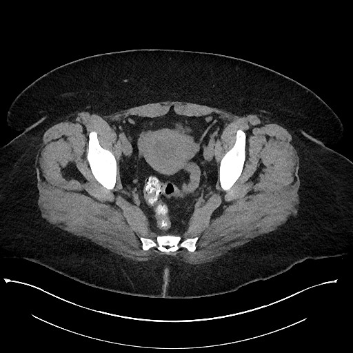 Carcinoid tumor - terminal ileum (Radiopaedia 60931-68740 Axial non-contrast 107).jpg