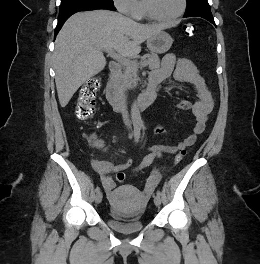 Carcinoid tumor - terminal ileum (Radiopaedia 60931-68740 Coronal non-contrast 45).jpg